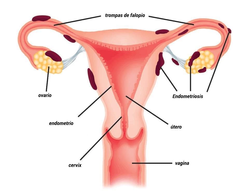 endometriosis