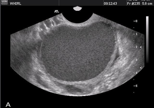 Endometrioma