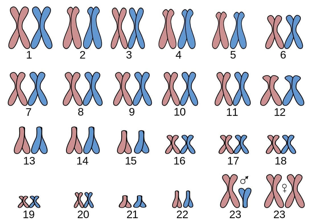 Síndrome de Down o Trisomía del cromosoma 21