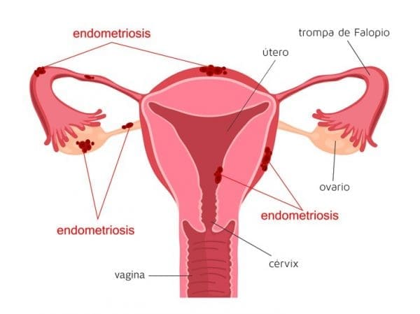 Sistema reproductor femenino con endometriosis