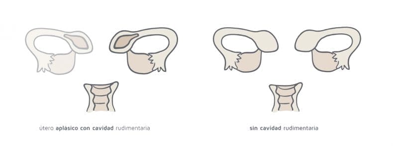 útero aplásico o displásico