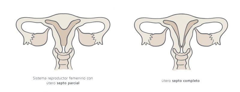 Útero septo parcial y útero septo completo