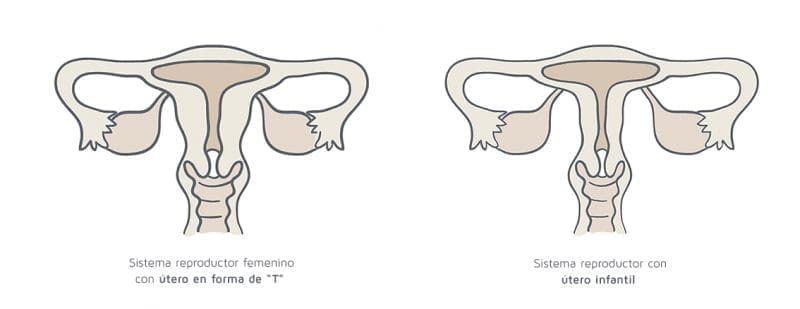 utero-forma-t-infantil