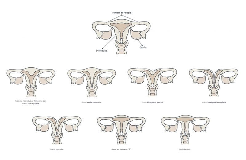tipos de útero