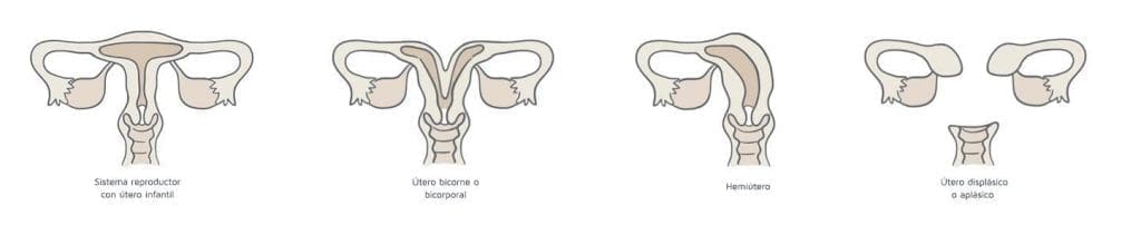 tipos de útero